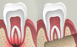 Удаление кисты на корне зуба
