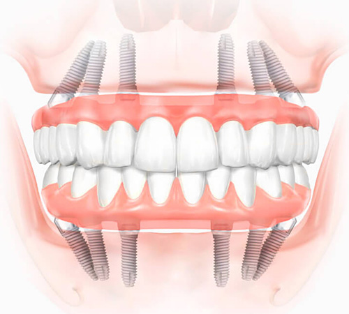 Имплантация и протезирование при полном отсутствии зубов