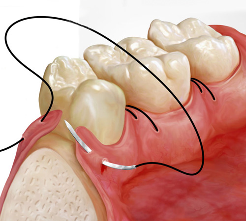 Лечение рецессии десны (оголения шейки и корней зубов) в стоматологической клинике Литфонда