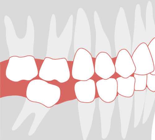 Почему удаленные зубы обязательно протезировать