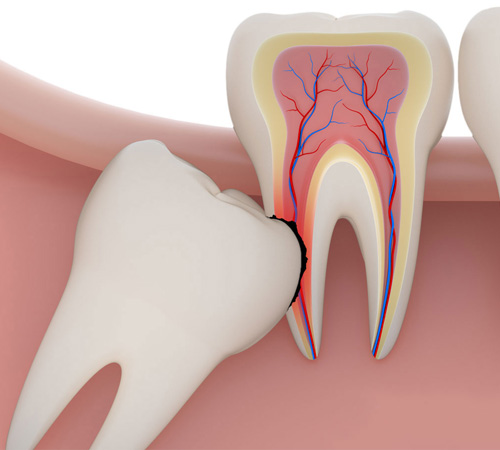 Удаление зуба с одновременной установкой зубного импланта в стоматологии Литфонда