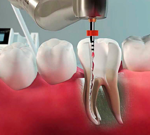 Лечение кариеса, пульпита и периодонтита в стоматологической клинике Литфонда