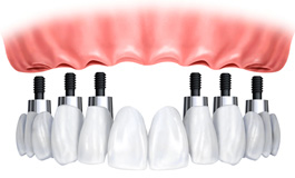 Имплантация и протезирование при полном отсутствии зубов
