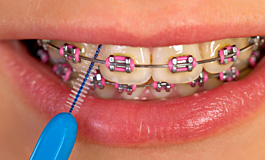 Уход за зубами и деснами при ортодонтическом лечении