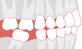Почему удаленные зубы обязательно протезировать