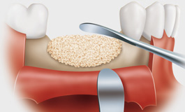 Костная пластика при установке зубных имплантов