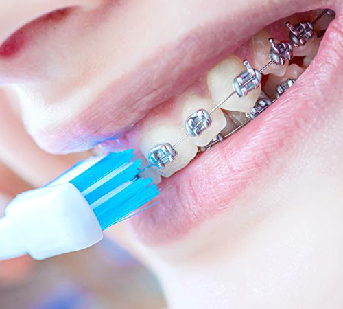 Чистка зубов в период исправления прикуса брекетами
