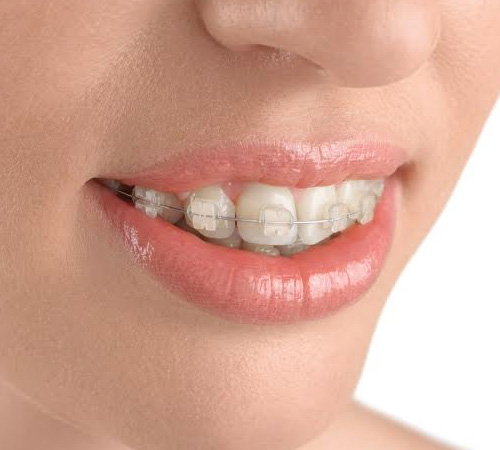 Силиконовые брекеты для выравнивания зубов: что это такое, в чем преимущества?