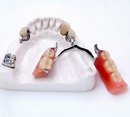 Бюгельный протез зубов на замках