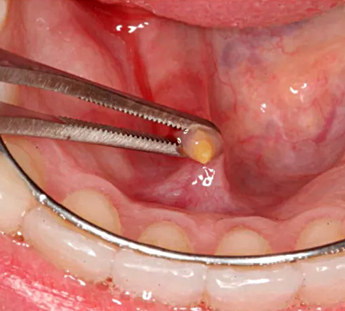 Удаление камней из протоков слюнных желез в стоматологии Литфонда