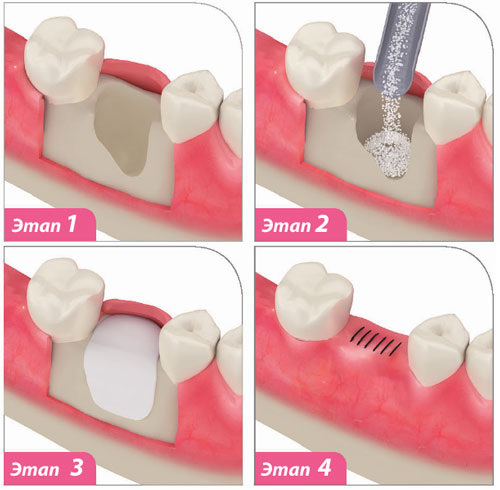 Заполнение лунки после удаления зуба материалом для костного роста
