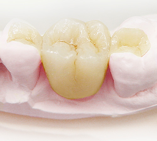 Адгезивный мостовидный протез на жевательные зубы